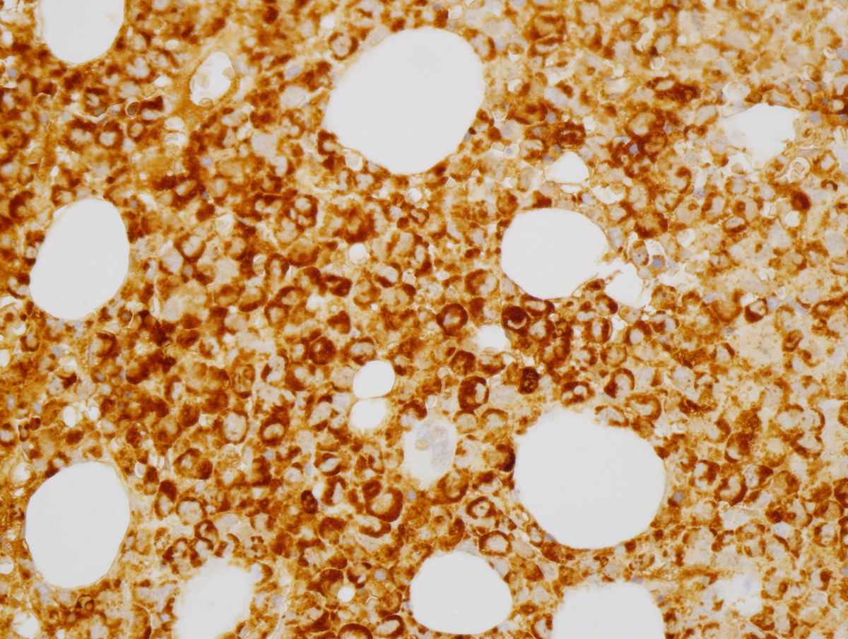Fig. 8 Bone marrow core biopsy. By immunohistochemistry the cells expressed CD45, CD33 (Fig. 8a), muramidase (Fig. 8b), CD99 (Fig. 8c), and focal weak CD68 (Fig. 8d). CD34, CD117 and myeloperoxidase were negative.